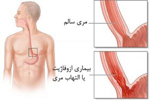 احساس درد در پشت بدن از نشانه های نسبتا شایع سرطان مری است