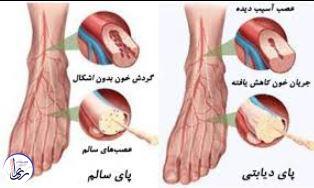 نوروپاتی دیابتی